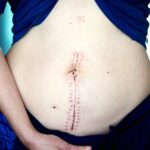 L'accouchement par voie basse après une césarienne
